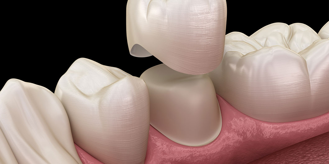 Zirconium Crowns DR Wonder Clinic stanbul