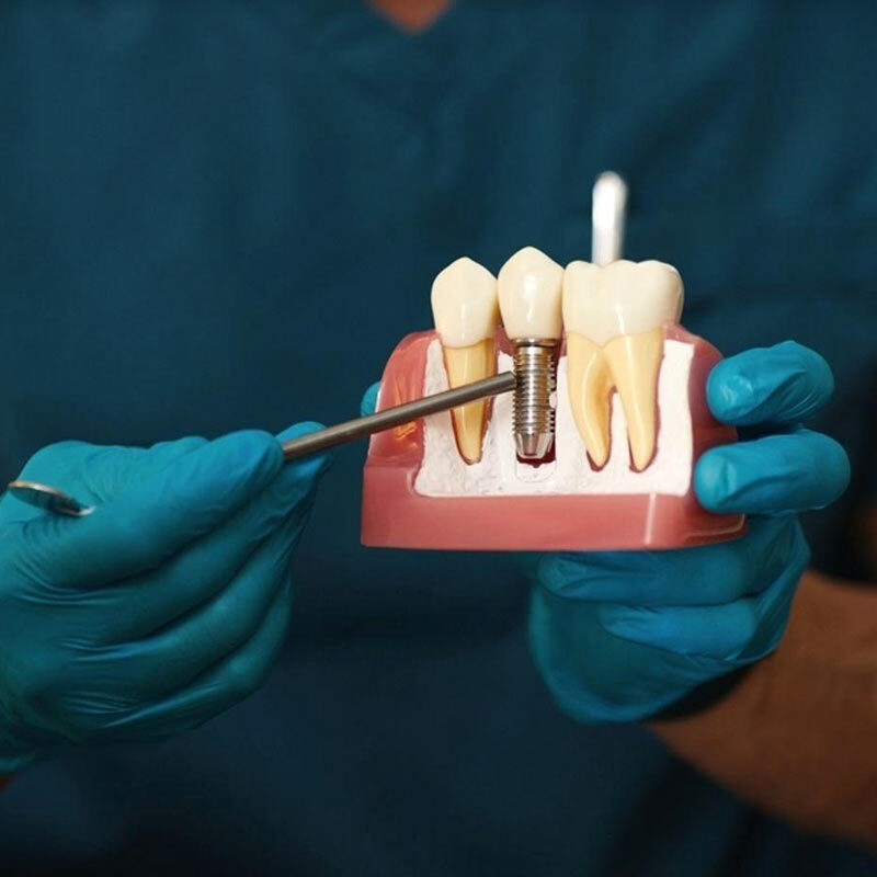 How much do dental implants cost?