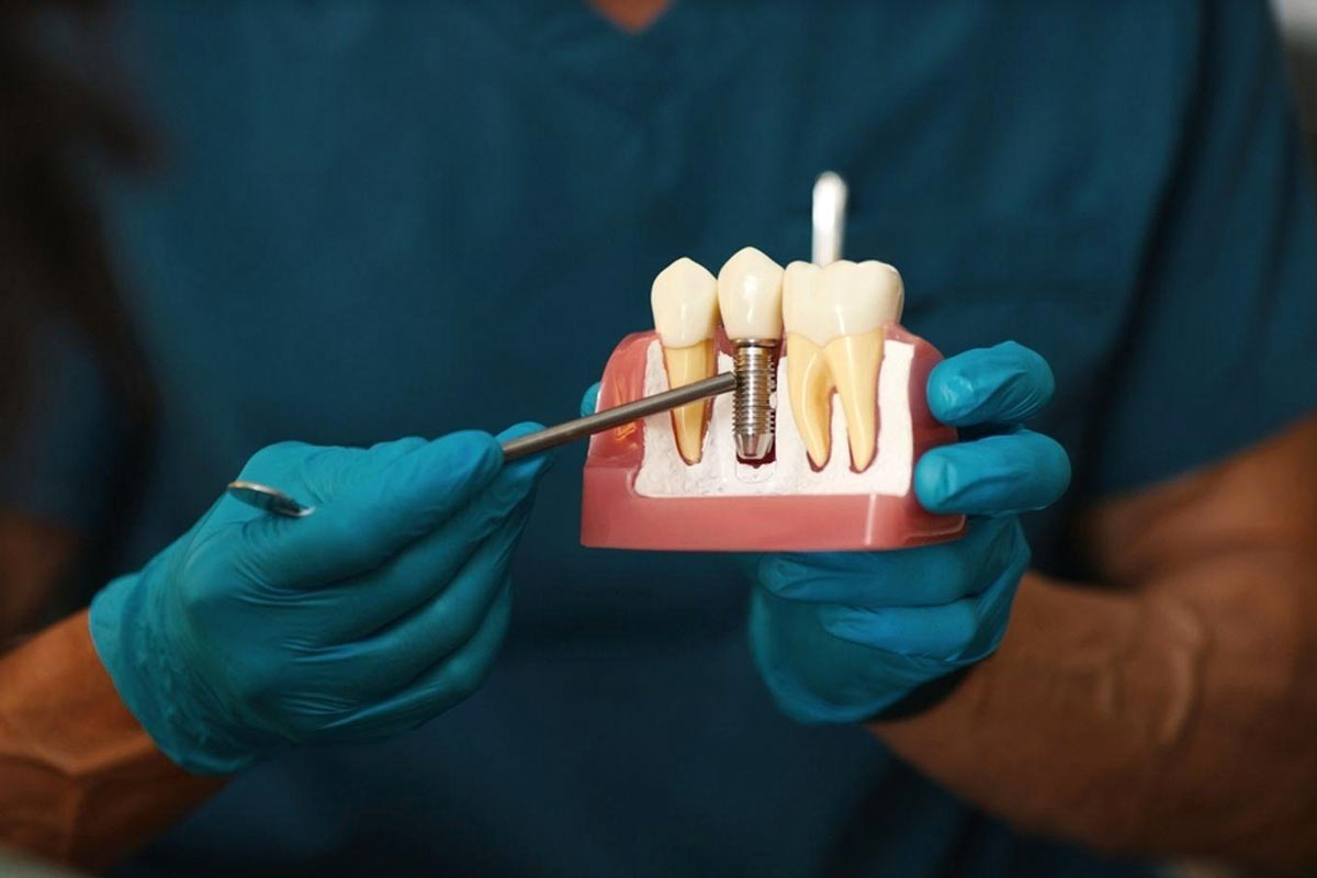 How much do dental implants cost?